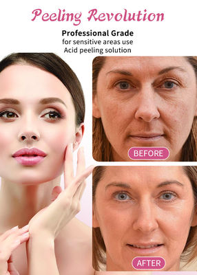 30 ml de soro para peeling da pele / conjunto de líquido profissional para solução de esfoliação da pele do rosto