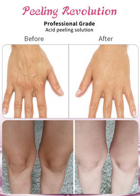 Solução para peeling de ácido de qualidade profissional
