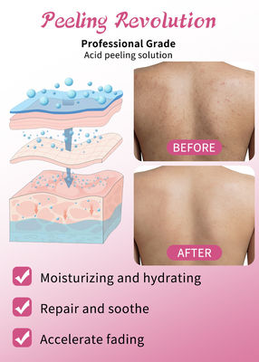 Serum de Esfoliação da Pele de Grau Profissional Produtos de Cuidados da Pele Limpeza Reparação da Pele Revitalize Solução Esfoliação