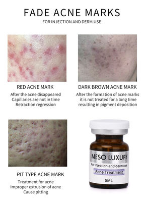 Os pontos vermelhos de Mesotherapy da injeção luxuosa do soro da juventude descascam o tratamento da injeção da acne