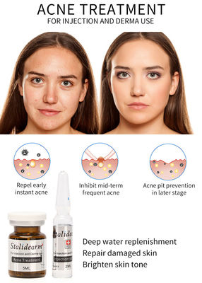 Soro Mesotherapy da injeção do tratamento da acne de Stalidearm que não nutre nenhum efeito secundário